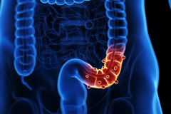 Diverticulitis and Diet Blog
