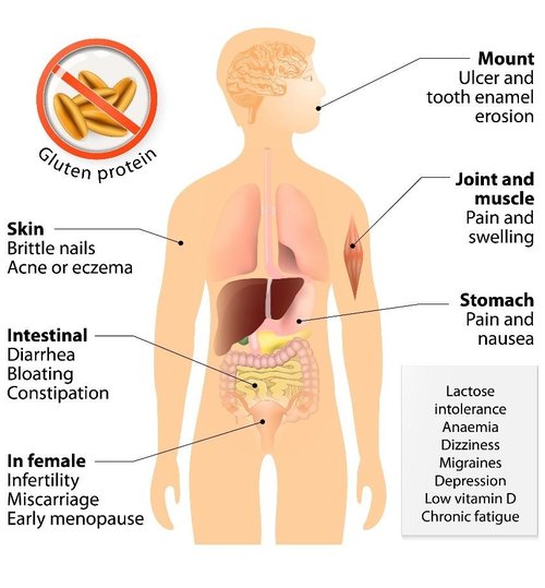 Coeliac Disease - What is it and why should we be more aware?